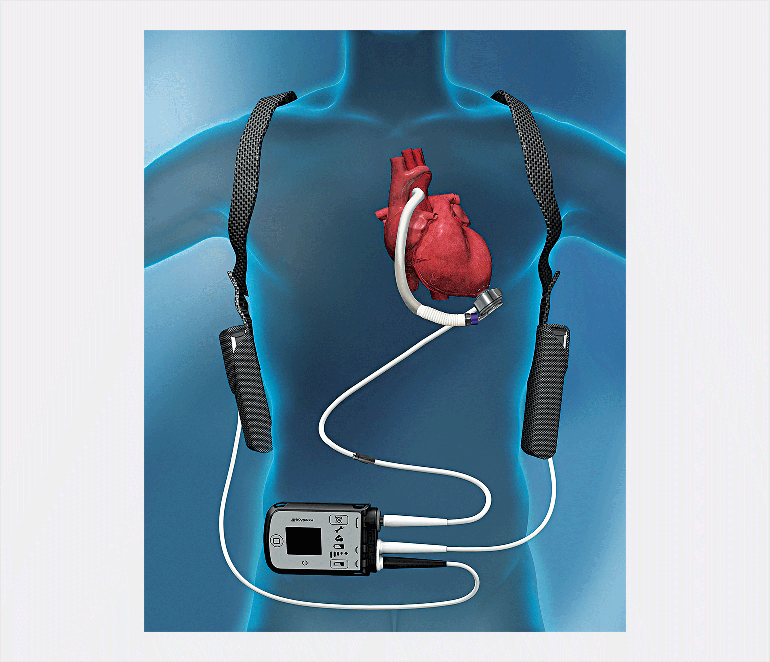 Heartmate3 mechanical circulatory support device