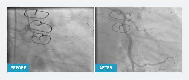 A chronic total occlusion before and after CTO PCI showing restored arterial blood flow