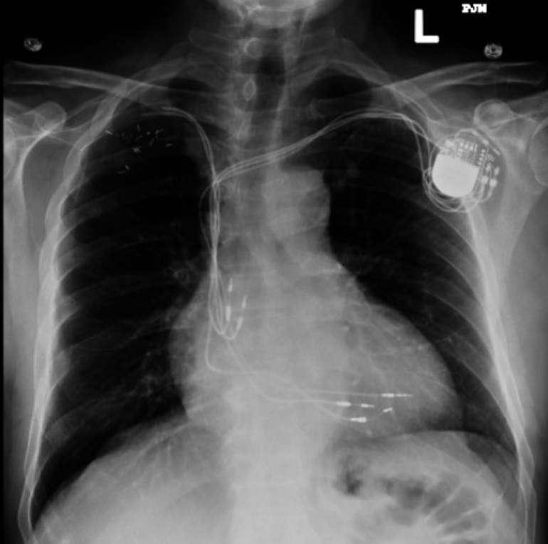 Cpt Code For Pacemaker Atrial Lead Revision