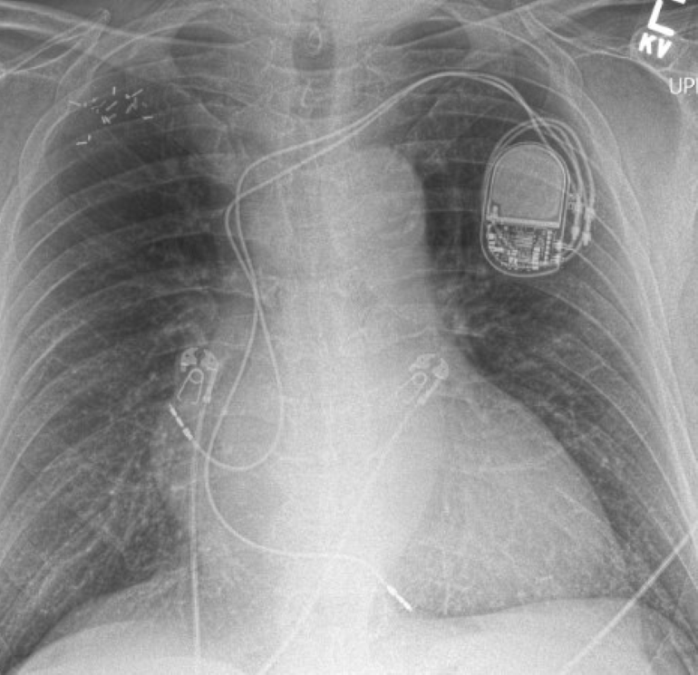 Advancing Pacemaker Lead Extraction and Revision Mass General