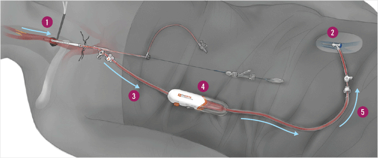 ENROUTE procedure visual explanation