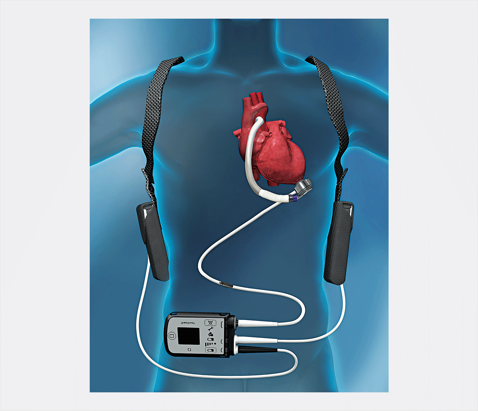 The Promise of Ventricular-Assist Devices (VADs) - Mass General ...