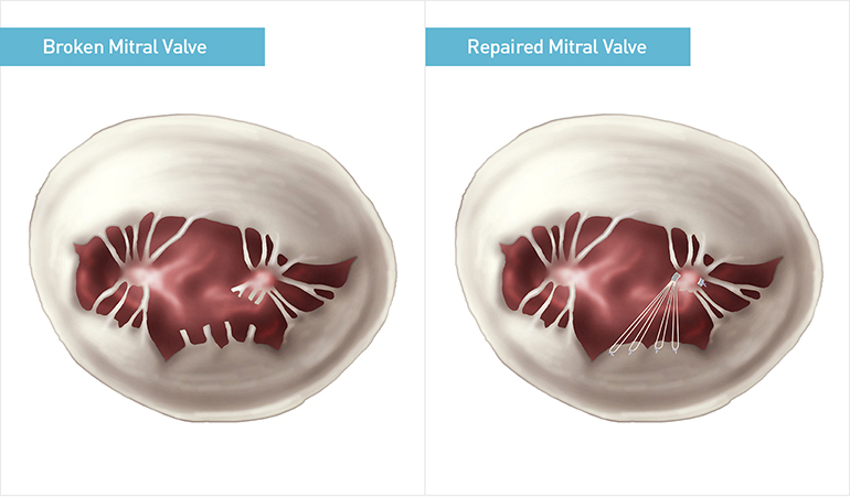 Guidelines for mitral valve surgery