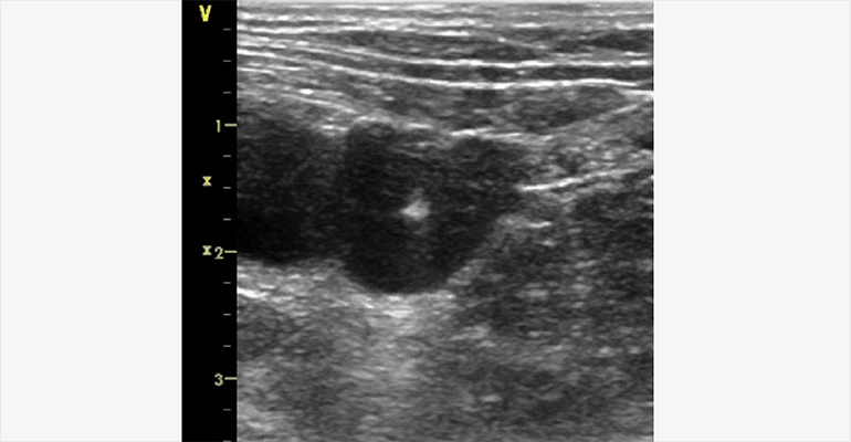 Ultrasound Image of Femoral Artery and Vein During Vascular Access