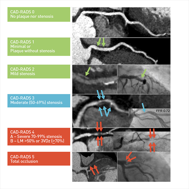  Illustration of CAD-RADS modifiers