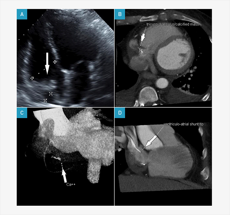 ECG gated computed tomography and echocardiography images of right atrial thrombus