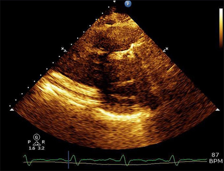 Echo image of pulmonic valve prosthesis with shadowing