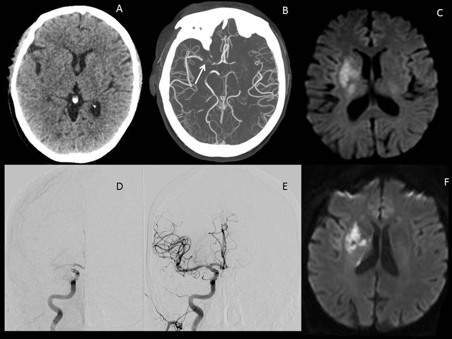 A New Approach to Induced Hypertension for Large Vessel Stroke Mass