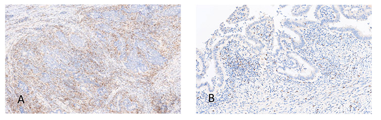 PD-1 Expression