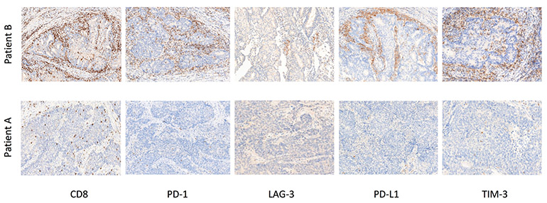 High-grade Endometrioid Patient Cohort Co-expressors