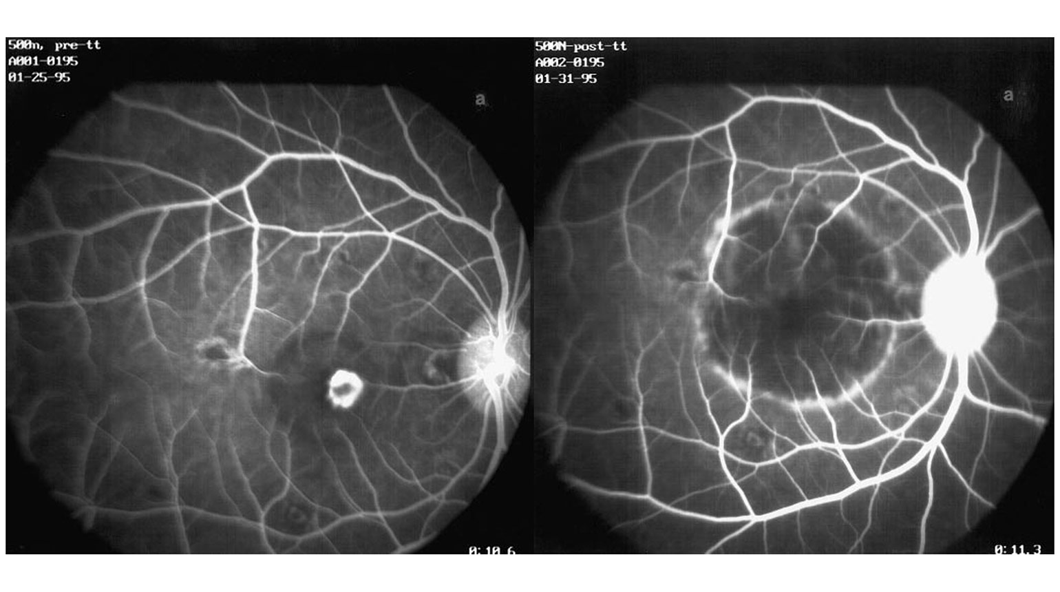 Early-phase fluorescein angiogram of the non-human primate CNV model before (left) and 24 hours after PDT (right), showing an absence of angiographic perfusion and leakage from the CNV after PDT