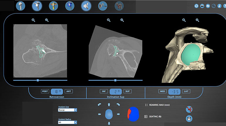 Virtual planning software showing templates of the glenoid prosthesis