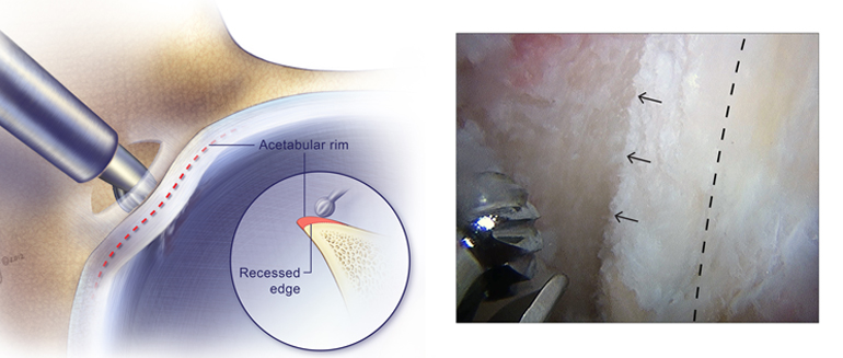 Acetabular recession of a pincer lesion with a 4mm round abrader. Chondrolabral junction is preserved.