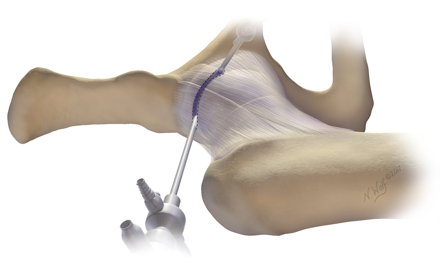 Use of Puncture Capsulotomy During Hip Arthroscopy Mass General