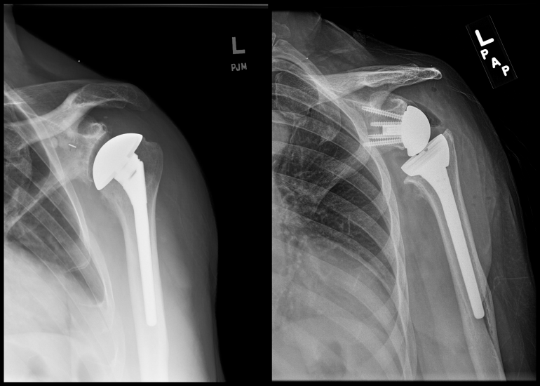 Improving Reverse Total Shoulder Arthroplasty Performance with HXLPE ...