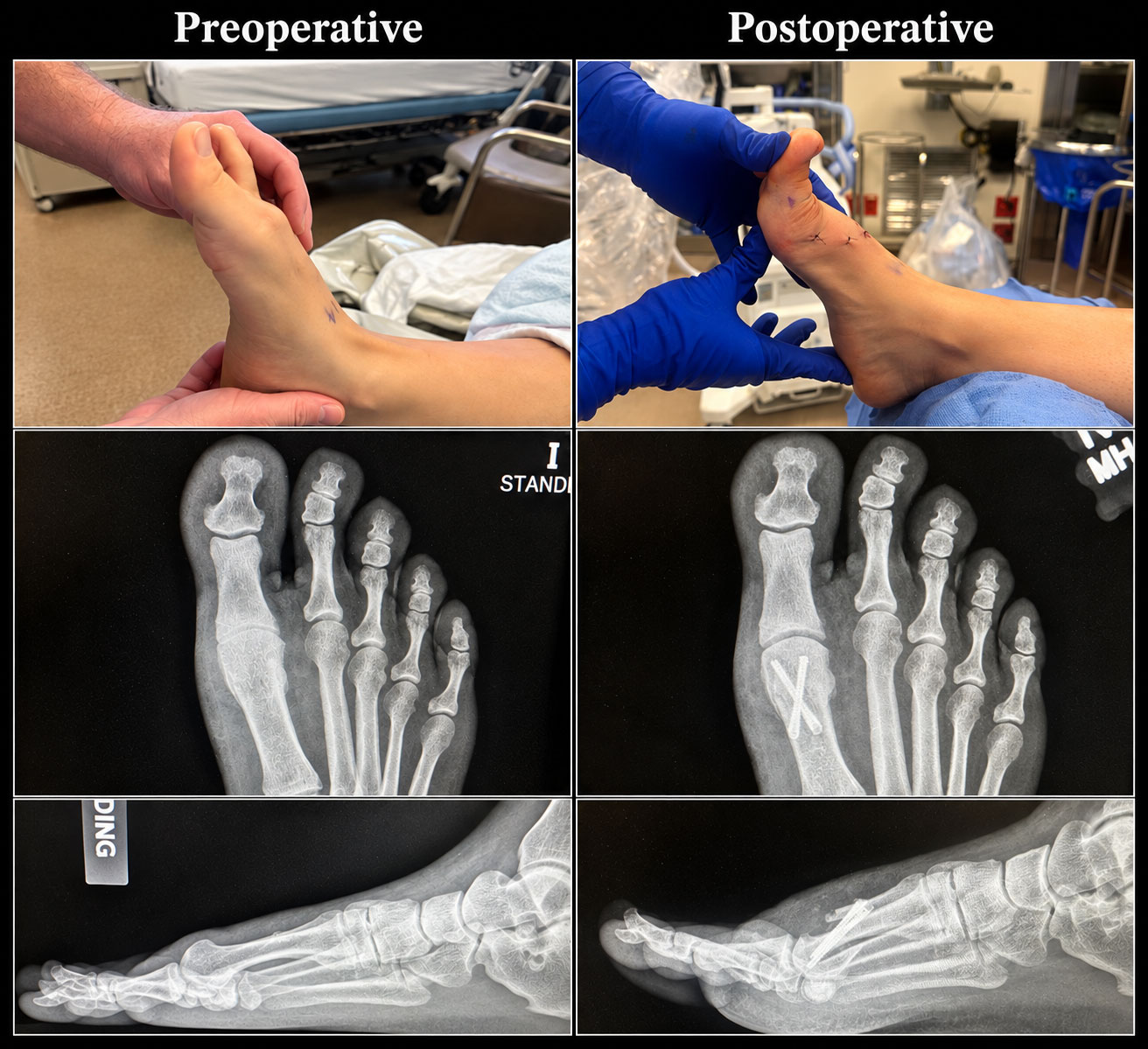 X-rays and external photos of the foot of a person with hallux rigidus taken before and after the operation, showing how the joint is fused after the operation.