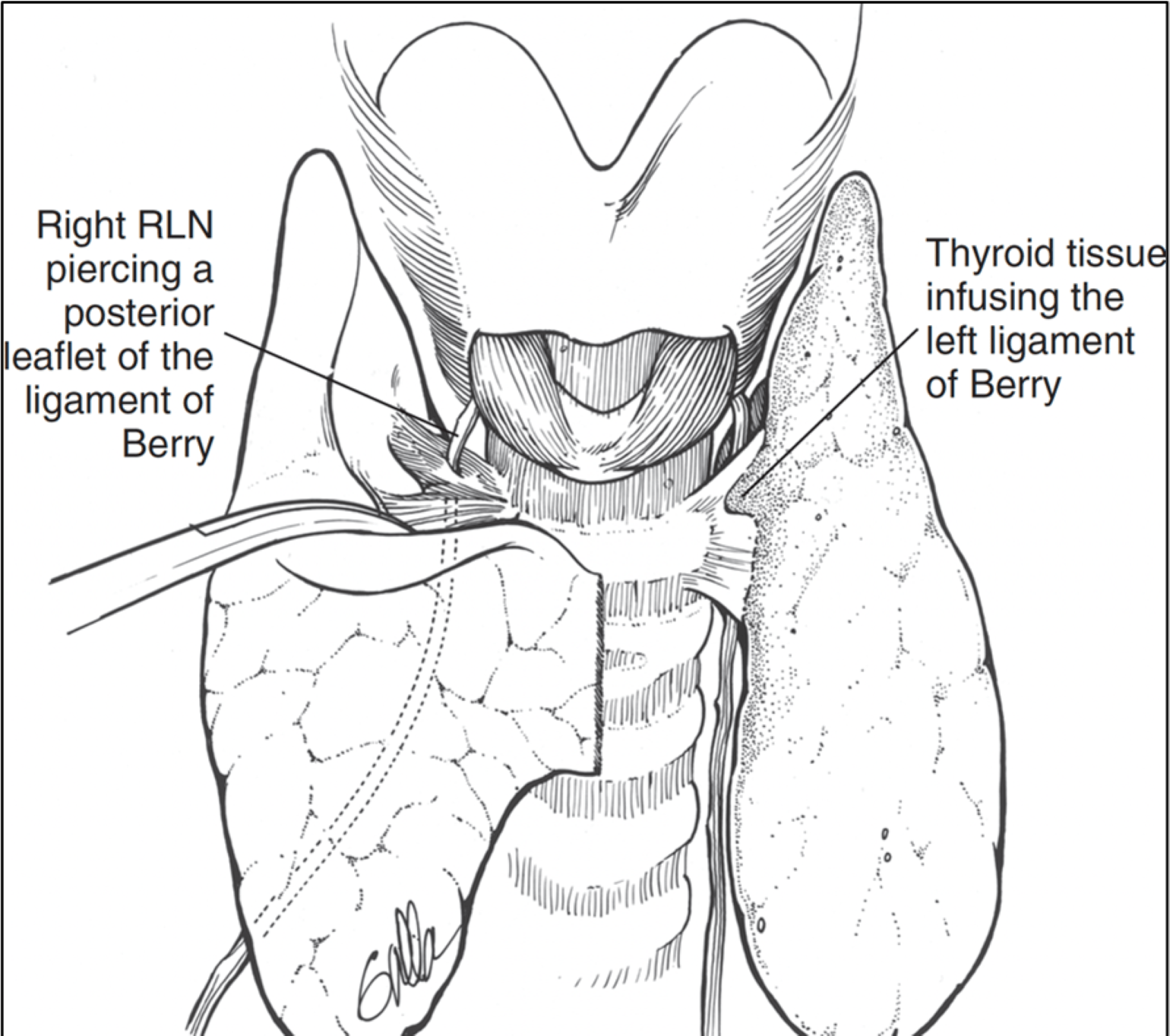 vocal-cord-paralysis-treatment-via-needle-injection-injection