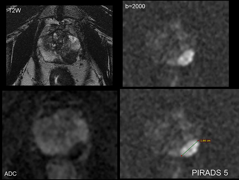Multiparametric Mri For Prostate Cancer Mass General Advances In Motion 9602