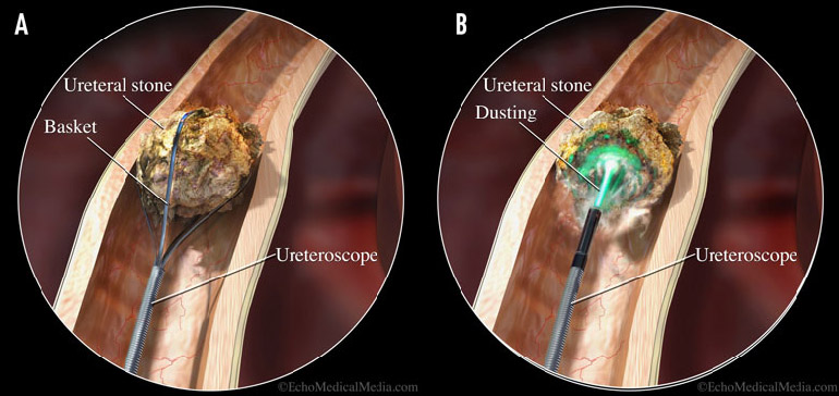 Dusting V Basketing Strategies For Disintegrating Renal Stones Mass General Advances In Motion