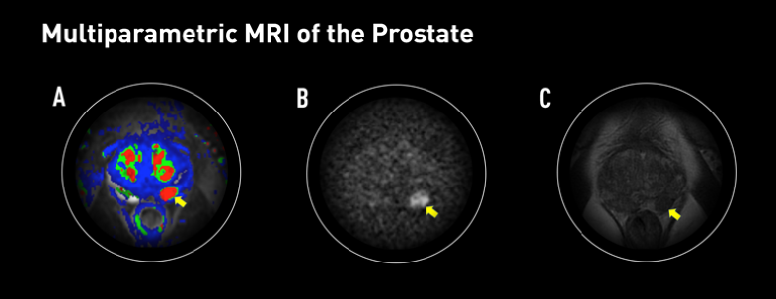 Multiparametric MRI Ultrasound Fusion Biopsy Improves Prostate Cancer Multiparametric MRI Ultrasound Fusion Biopsy Improves Prostate Cancer